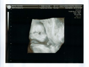 The little one at 20 weeks